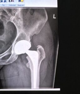 Recovering from Hip Replacement: a 10 week journey