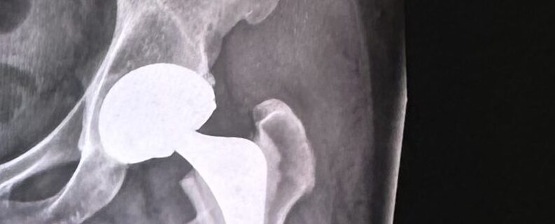 My dual mobility new hip