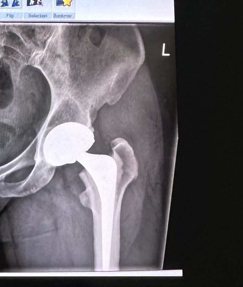Recovering from Hip Replacement: a 10 week journey